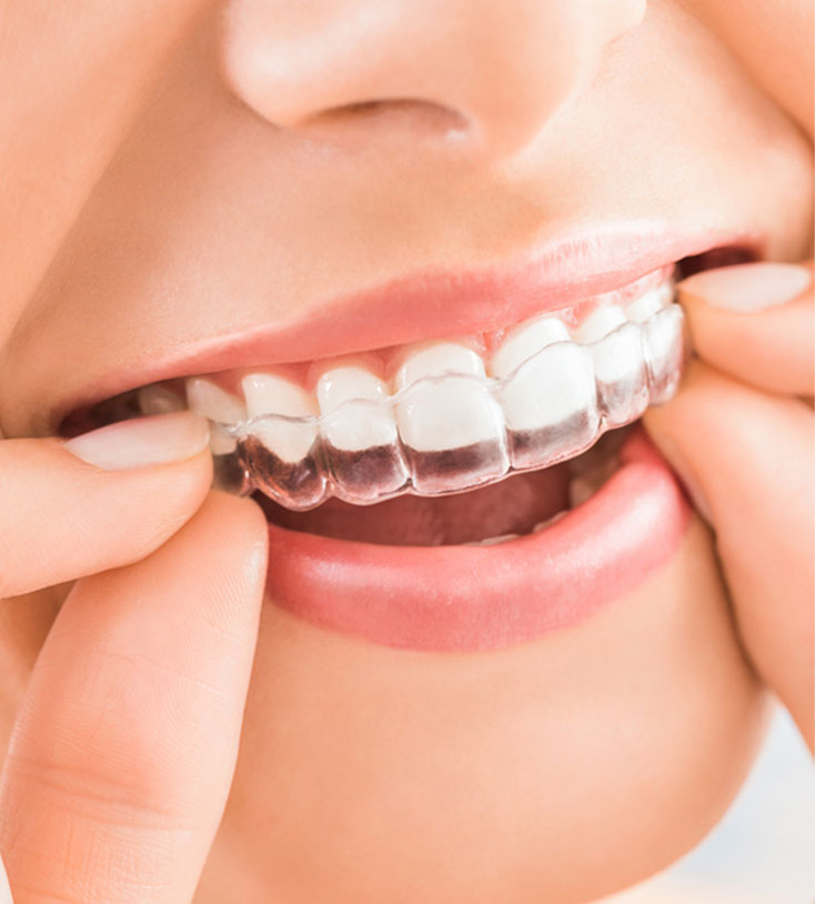 Vad är skillnaden mellan olika aligners – och varför vi väljer Invisalign