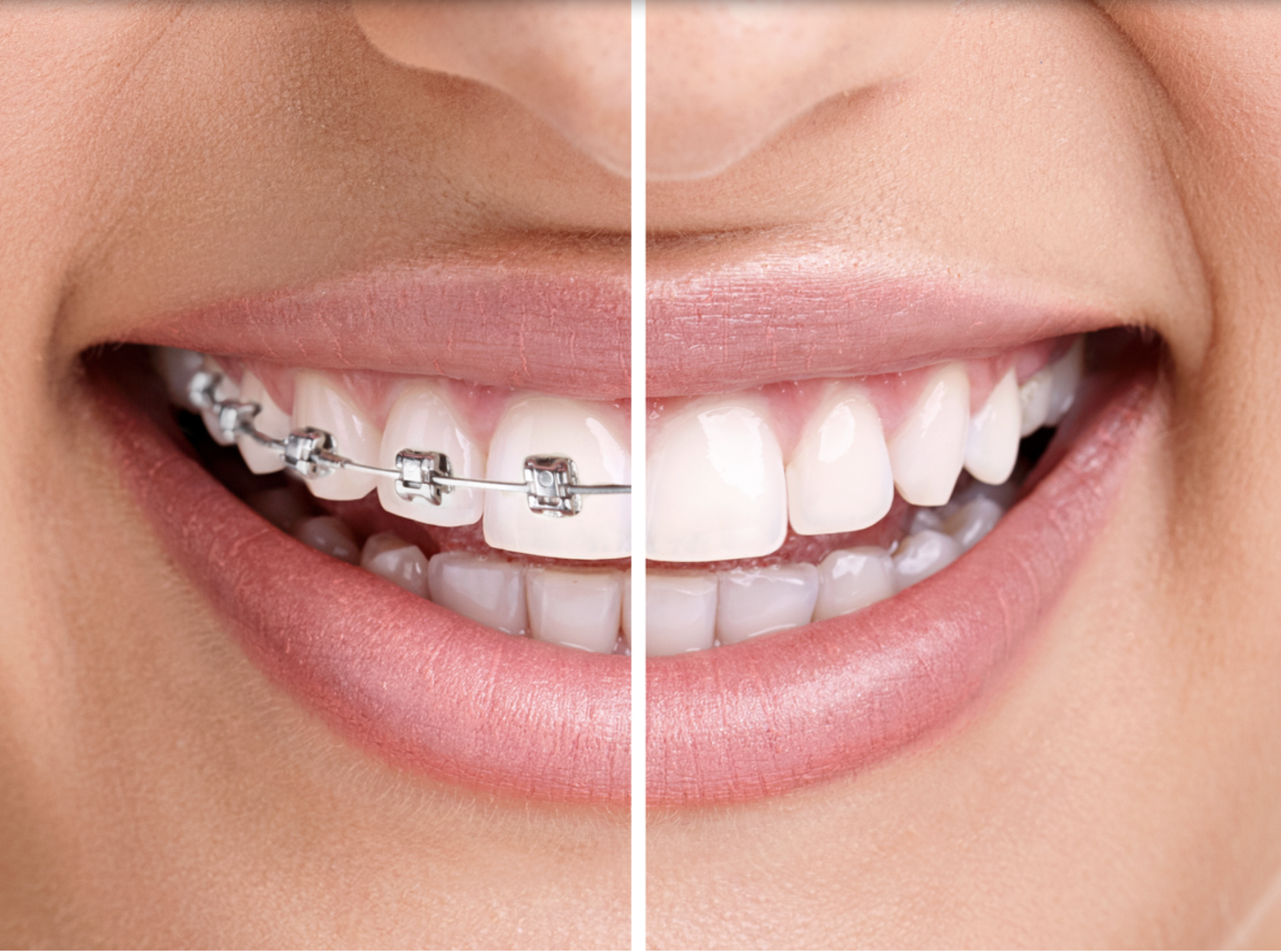 Invisalign, Incognito eller vanlig räls – vilken tandställning passar dig?