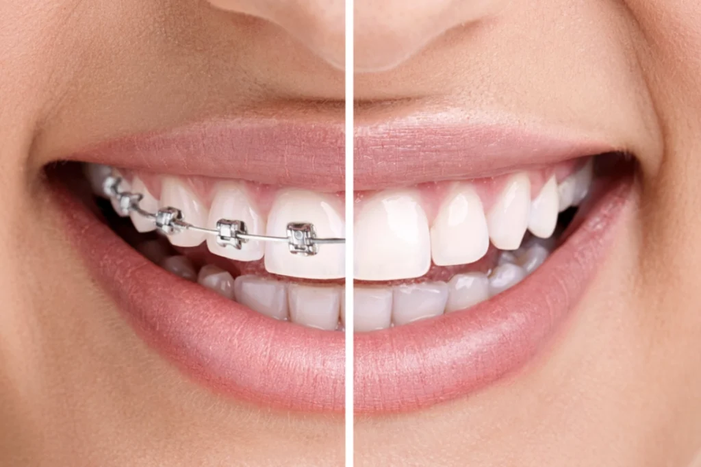 Invisalign eller vanlig räls